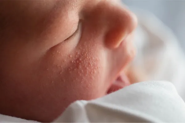 Prosaki na twarzy noworodka